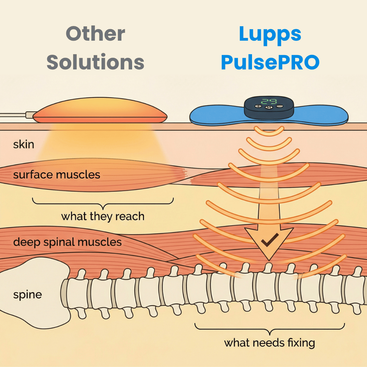 Lupps™ Pulse PRO